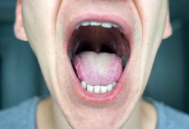 what does having a scalloped tongue mean