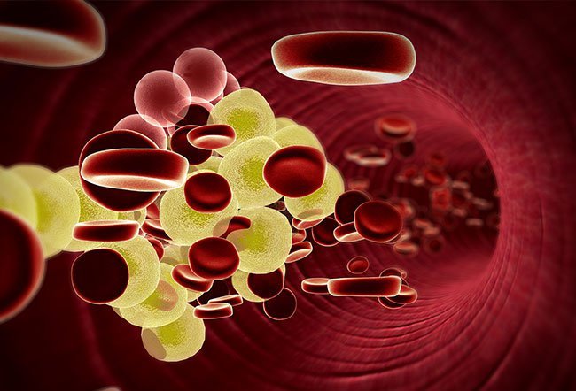 Hyperlipidemia is the medical term for high cholesterol. Hyperlipidemia usually has no symptoms, so many people may not be aware that they have high cholesterol.
