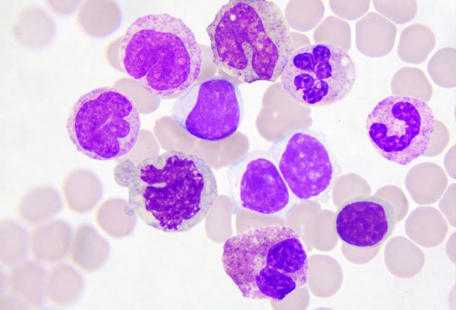 Monocytosis or a monocyte count higher than 800/µL in adults indicates that the body is fighting an infection.