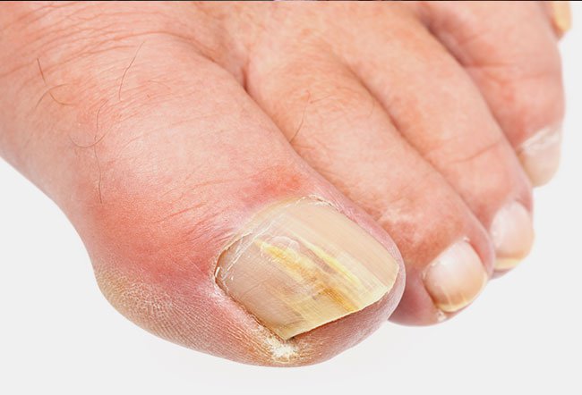 what causes toenails to thicken
