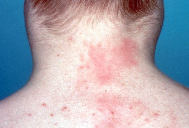 what does a lymphoma skin rash look like