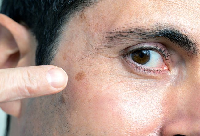 The appearance of skin cancer on the face may vary depending on the type of skin cancer.