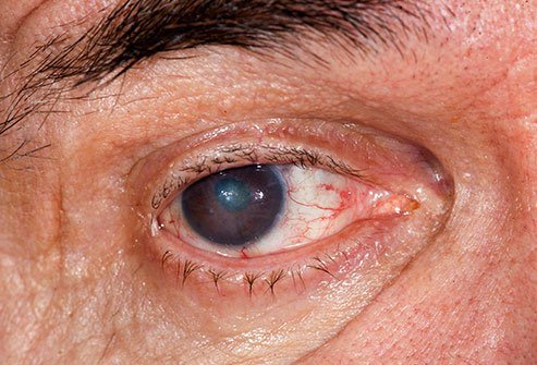 People who have brown eyes are more likely to get cataracts than those who have blue eyes.