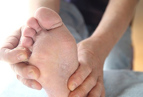 Athlete's foot is a contagious foot infection caused by fungi. These fungi thrive in closed, warm, moist, damp environments such as locker rooms, showers, and swimming pool areas and even moist socks. A scaly rash between the toes stinging, burning, and itching are common for this contagious condition.