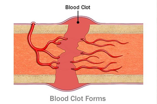 Your body starts healing a broken bone within just a few hours of the injury.