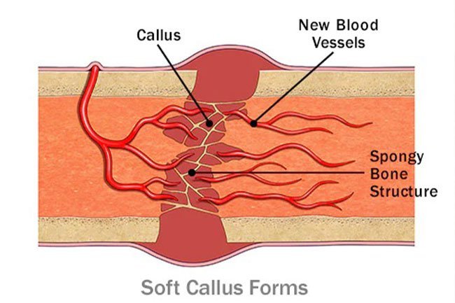 A callus forms in the area of the broken bone while it's healing.