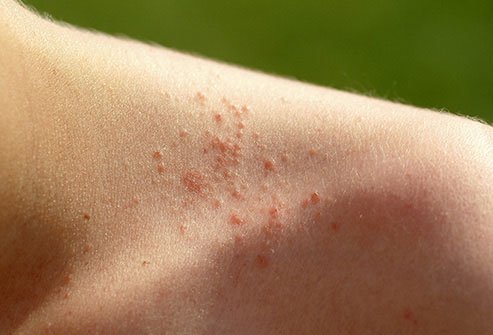 It happens, often in hot humid weather, when you sweat so much that your sweat glands get blocked.