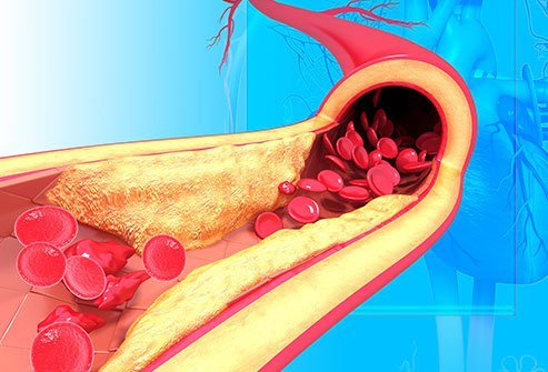 High blood pressure, or HBP, pushes too hard on your artery walls.