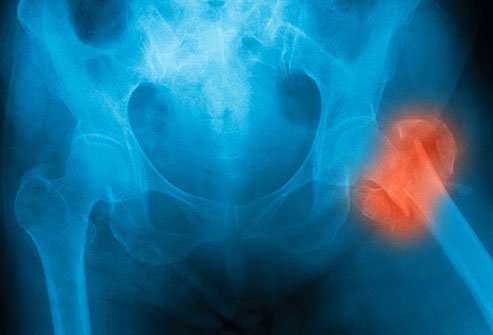 People with high blood pressure often have more calcium in their urine.