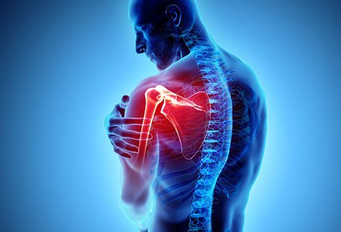 The Bristow procedure fixes shoulder instability due to shoulder blade (scapula) deformity.