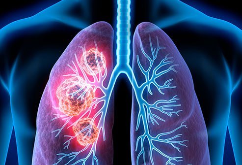 A surgery for lung cancer, bronchovascular sleeve resection helps preserve blood supply in the lungs.