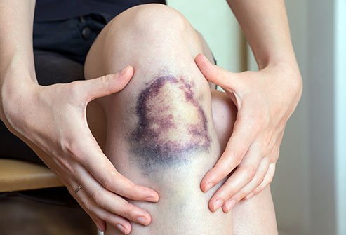 Broken small blood vessels cause bruises.