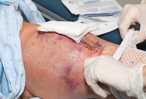 A compartment pressure measurement test