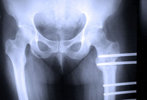 A femoral osteotomy corrects deformities of the femur (thigh bone).