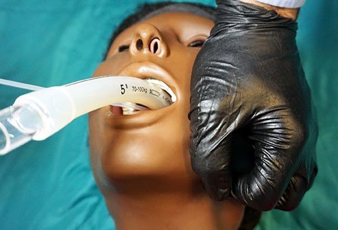 A laryngeal mask airway (LMA) allows ventilation, oxygenation, and anesthesia without a tube in the windpipe.