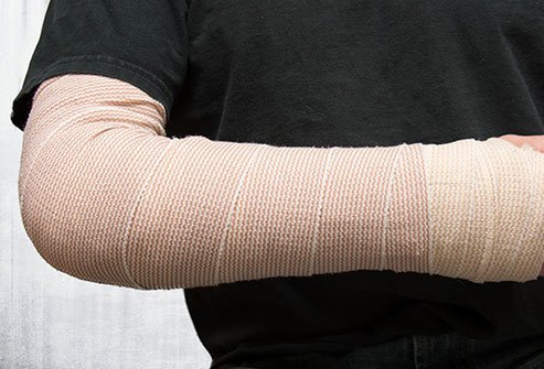 A splint is a rigid device used to stabilize broken bones or dislocated joints. Often a splint is temporarily applied in an emergency as a stopgap measure until a doctor can set the bone properly.