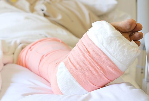 Posterior Long Leg Splinting