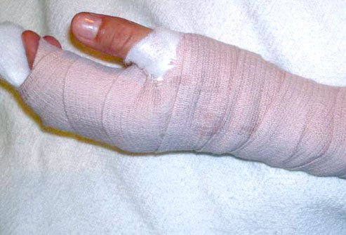 A radial gutter splint immobilizes the index and middle fingers after a fracture. It's called 