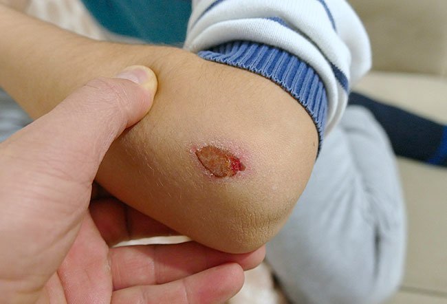what is a scab on a wound
