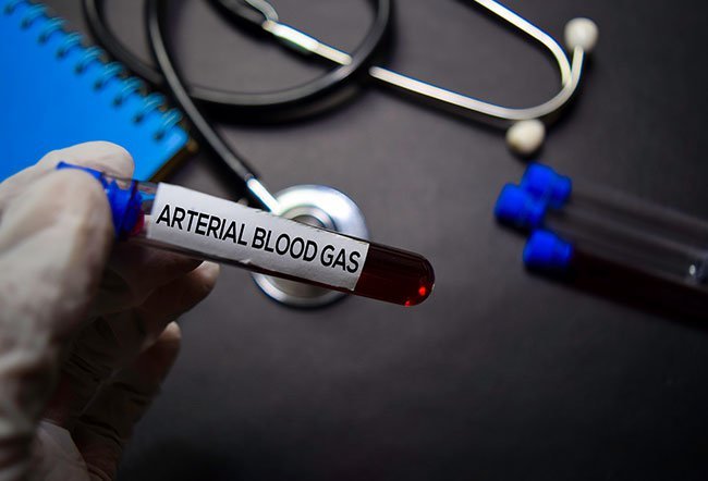 An arterial blood sample analyzes the concentration of 
certain gases dissolved in the blood.