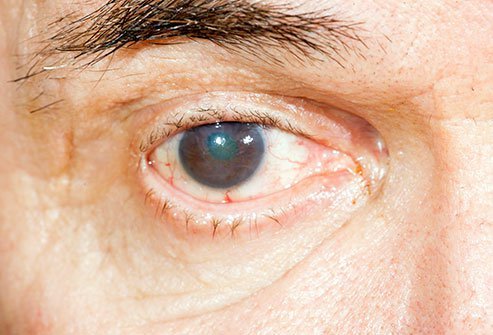 Ectropion of the eyelid is an outward bending or turning of the eyelid margin
