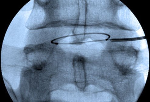 Intradiscal electrothermal therapy (IDET) is a minimally invasive technique that treats low back (spinal disc) pain.