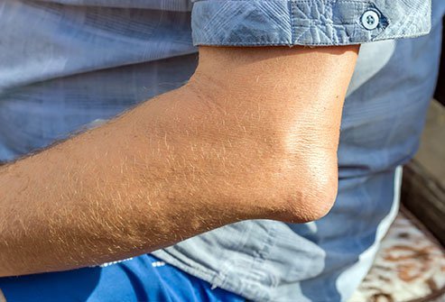 Aspiration of the olecranon bursa is the drainage by needle of the fluid inside the lubricating fluid sack (bursa) at the tip of the elbow.