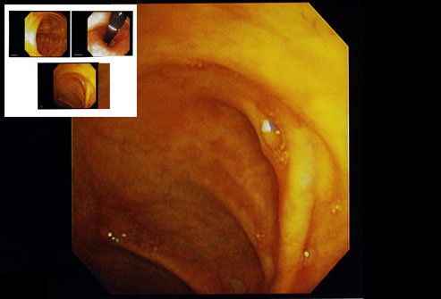 Chromoendoscopy