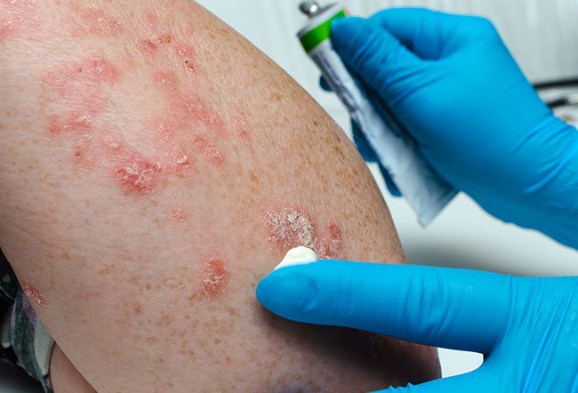 Hydrocortisone is a corticosteroid that is available as an over-the-counter (OTC) medication. Hydrocortisone can address skin problems, such as eczema, psoriasis, contact dermatitis, insect bites, diaper rash, neurodermatitis and other conditions.