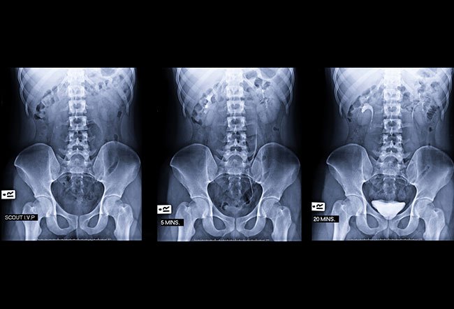 A kidney, ureter, and bladder (KUB) X-ray is a diagnostic test that can detect kidney stones and diagnose urinary tract disorders.