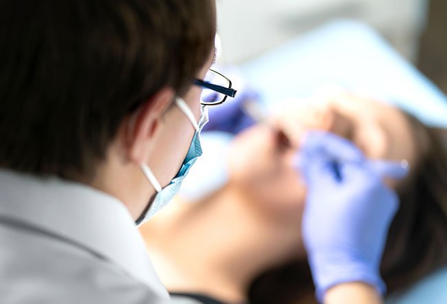 An oral brush biopsy is a technique to screen the oral cavity of individuals who have a high risk of developing mouth cancer.