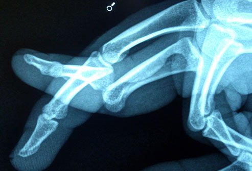 Finger Dislocation