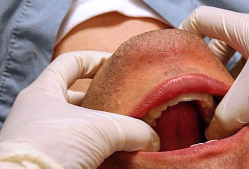 Mandibular Dislocation