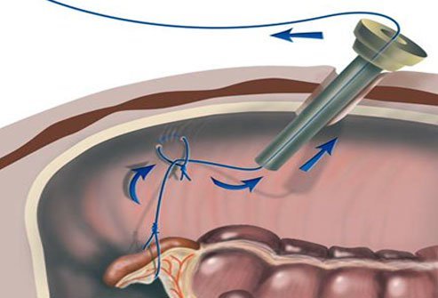 Single-port Appendectomy