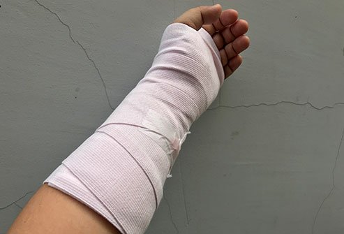 Splint