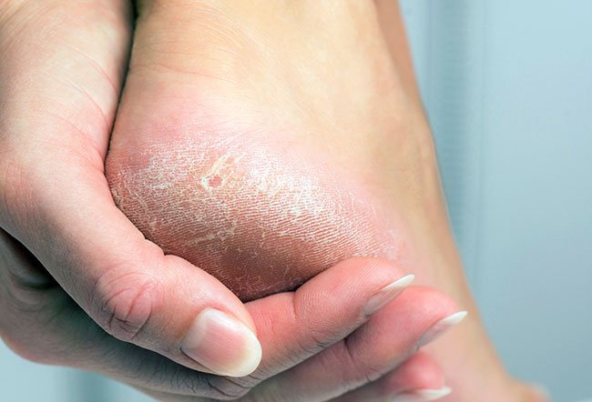 Best foot callus removers contain a gentle but highly effective scrubbing mechanism.