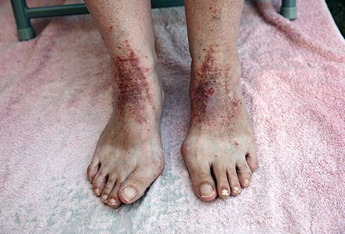 The most effective way to treat stasis dermatitis is by controlling the disease