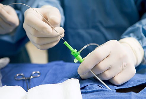 Heart ablation or cardiac ablation is a procedure done to rectify problems with heart rhythm (arrhythmias).