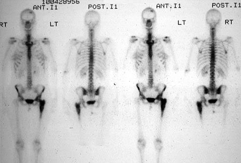 Lymphoma