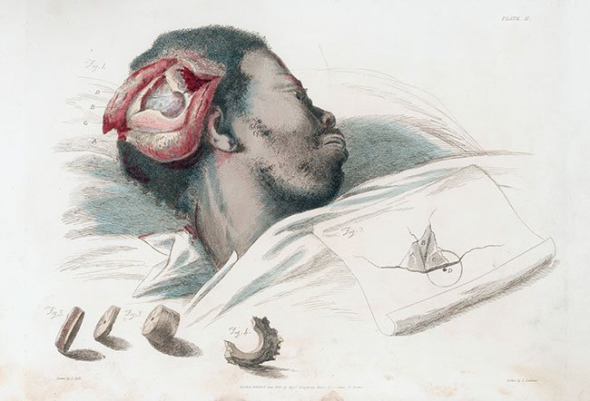 trepanation