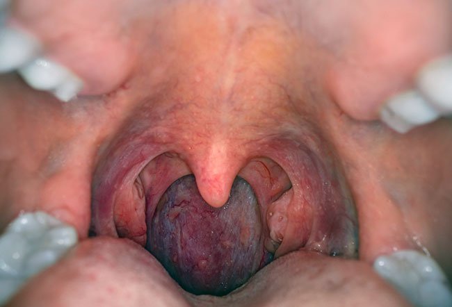 The walls of the pharynx are attached to the margins of the nasal cavity, oral cavity, and larynx.