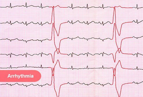 It means your heart has an irregular beat.