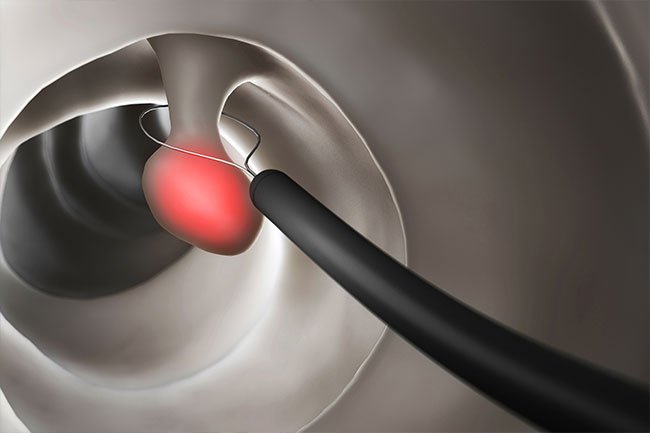 Polyps will be remove if the doctor finds them because they may be precancerous.