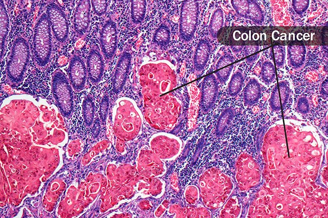 The doctor may take a biopsy of a suspicious area during a colonoscopy.