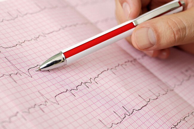 There are four major types arrhythmia heart rhythm disorder.