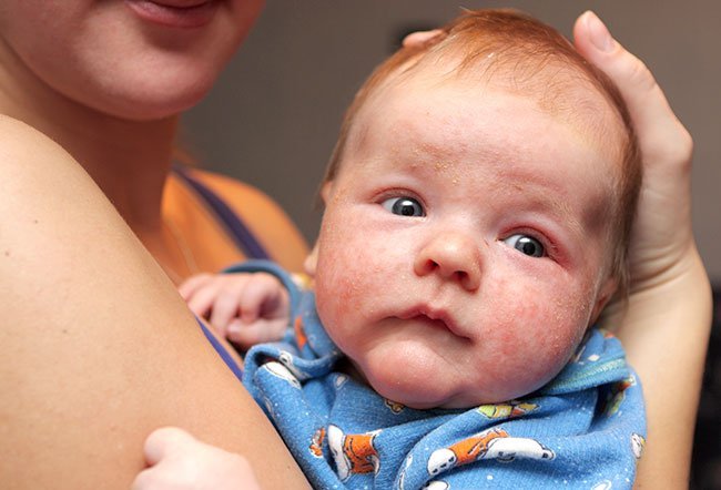 Although the cause of eczema isn't completely understood, up to 10 percent of babies and toddlers have it. Triggers for eczema in babies include irritant, allergens, environmental factors, food, sensitive skin, stress, animals, herpes viral infection and stress.