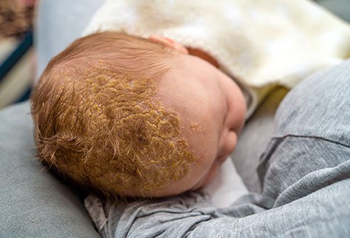 Seborrheic Dermatitis