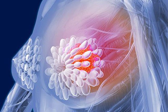 Women who have estrogen-receptor positive breast cancer should not use HRT.