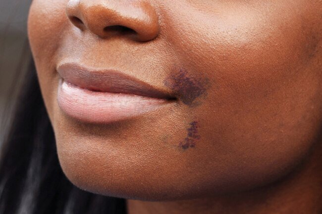 It is normal to have bruising, redness, mild bleeding, and discomfort after getting fillers.