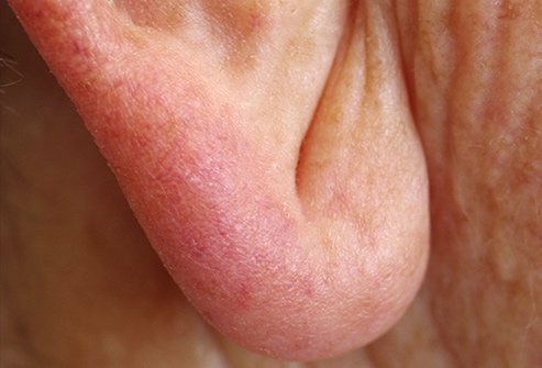 A crease in your earlobe may be a sign of heart disease. 